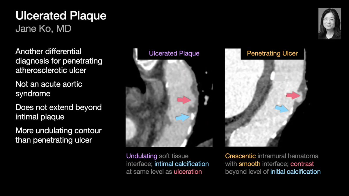 Review of acute aortic disease from Dr. Jane Ko’s talk at #STR2021. Curated by @Ftamizuddin. Differential diagnosis for penetrating atherosclerotic ulcer: • ulcer-like projection (ULP) • ulcerated plaque [4/5] #radres #Radtwitter #MedTwitter #FOAMrad #FOAMmed