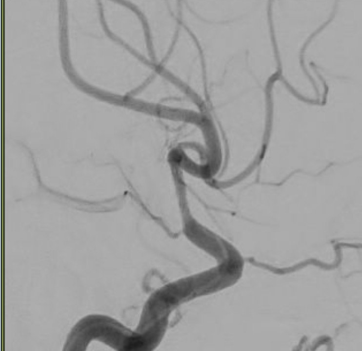 LVO with underlying ICAD. Single pass with Stentriever/Aspiration and coronary stent Synergy 2.25x12...submaximal inflation as Anterior Chorodial at risk of snowplowing! @HamedAsadi @DPremrl @AmeerEHassan