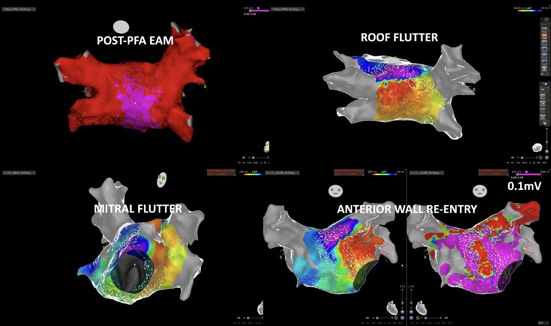 Post-PFA AT. Durable PVI. Significant roof scar responsible for roof flutter. Mitral flutter and anterior wall reenrty were additionally seen. @SteliosDragasis. @ipetemil @athsaplaouras @CosmoValkanas @MEfraimidis #onassiscardiacsurgerycenter