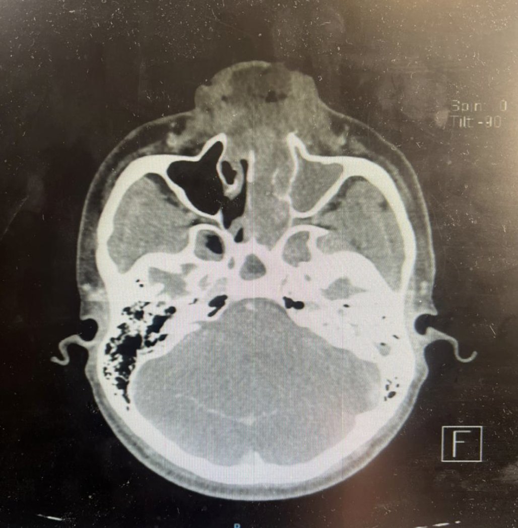 El #linfoma extra ganglionar de #célulasNK/T , es una neoplasia que tiene una mayor inicidencia en Latinoamérica y Asia, y suele considerarse una neoplasia poco frecuente en la población de Europa occidental y norteamerica.
El tratamiento de esta entidad varía entre instituciones