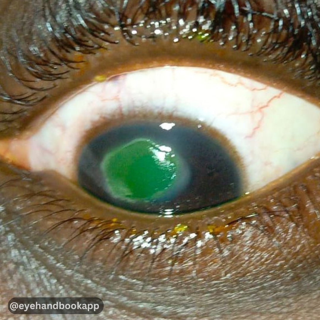 How would you manage this case?
Check ALT (image description) for more info.

#eyes #foreignbody #photophobia #tearing #clinicalcalculators #eyecalculators #ophthalmologist #optometrist #eyedoctors #ophthalmologyresident #optometryresident #oftalmologia #eyesight #vision