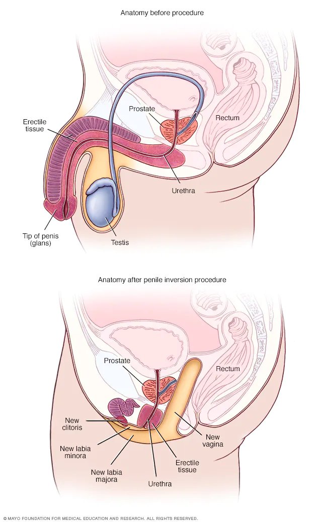 Regarding before and after male genital mutilation. Prostate moved forward. Epididymis severed. Erectile tissue base remains. Notice how thin the gap is between rectum/cavity.