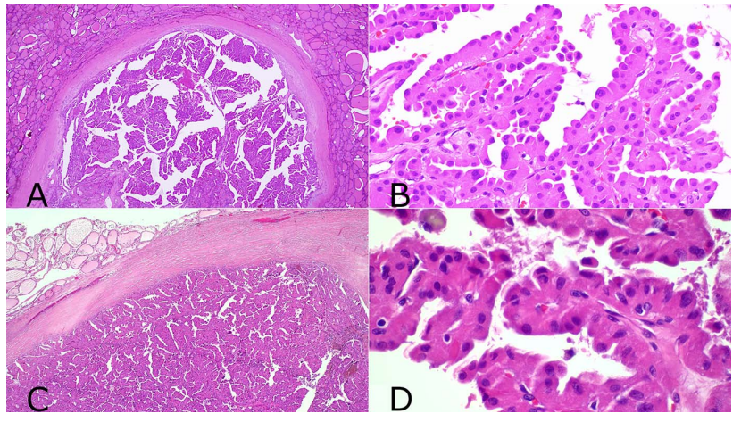 New article online ahead of print! Thank you @ArchivesPath ! Study examining unusual variants of papillary oncocytic thyroid neoplasms! pubmed.ncbi.nlm.nih.gov/38100177/ #pathtwitter #surgpath @PathDocBoston