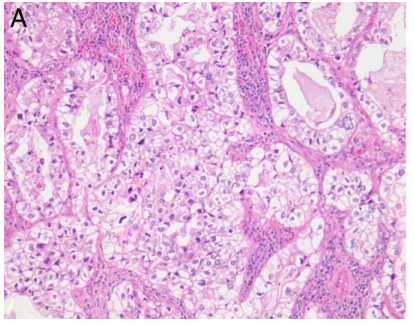 New article online ahead of print examining FGFR3 rearrangements in non-small cell lung carcinoma @AJSPjournal !!! Has anyone else run into this FGFR3::TACC3 fusion in the lung? Did the tumor have clear cells? pubmed.ncbi.nlm.nih.gov/38084010/ @pathtwitter #surgpath @smlungpathguy