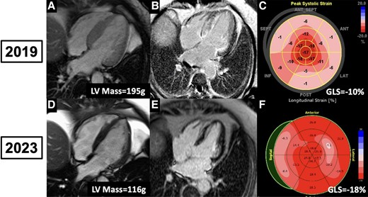 MSHCVImaging's tweet image. Now in @ESC_Journals, our group presents an incredible case of significant cardiac amyloidosis regression by CMR and Echo Strain. tinyurl.com/4zyvh2k4
@SWBienMD @doctorginaL @ferresc92 @MichaelHadleyMD @SinaiCards @MountSinaiHeart