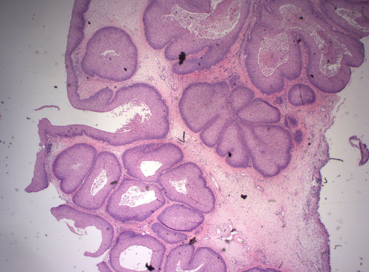 A beautiful nasal mass in 50s M to start the day. gonna be a good one! #HeadandNeckPath #PathX #PathTwitter