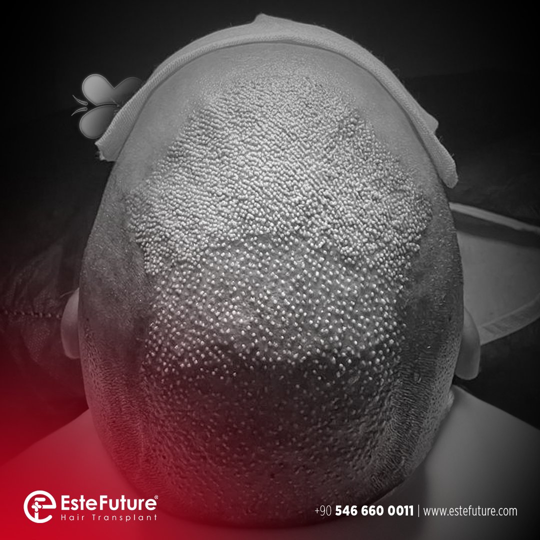 este_future's tweet image. 🌿 Care tips after hair transplant: Follow the doctor&apos;s instructions, keep the head elevated, avoid scratching and friction! Avoid smoking, alcohol, heavy sports. 💊 Use medications regularly, protect from the sun, do not disrupt the controls! #HairCare #RecoveryProcess ✨