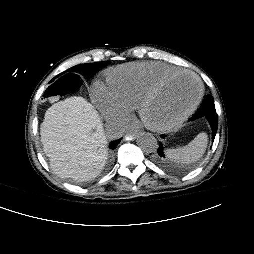 Daniel Vargas, MD (@danielvargasmd) on Twitter photo ✅Dilated LV, LA and LAA
✅Small pleural effusions with adjacent high attenuation atelectasis.
✅Adding the last piece: high attenuation hepatic parenchyma
➡️Amiodarone deposition lung & liver
<a href="/TLHM_MD/">Tan-Lucien Mohammed, MD, FACR</a> <a href="/jonherochung/">Jonathan Chung, MD</a> <a href="/JoannaEscalonMD/">Joanna Escalon, MD</a> <a href="/LeaAzour/">Lea Azour</a> <a href="/JordiBroncano/">Jordi Broncano</a> <a href="/CsFuss/">Dr. Cristina Fuss</a> #radres ✅Dilated LV, LA and LAA
✅Small pleural effusions with adjacent high attenuation atelectasis.
✅Adding the last piece: high attenuation hepatic parenchyma
➡️Amiodarone deposition lung & liver
<a href="/TLHM_MD/">Tan-Lucien Mohammed, MD, FACR</a> <a href="/jonherochung/">Jonathan Chung, MD</a> <a href="/JoannaEscalonMD/">Joanna Escalon, MD</a> <a href="/LeaAzour/">Lea Azour</a> <a href="/JordiBroncano/">Jordi Broncano</a> <a href="/CsFuss/">Dr. Cristina Fuss</a> #radres