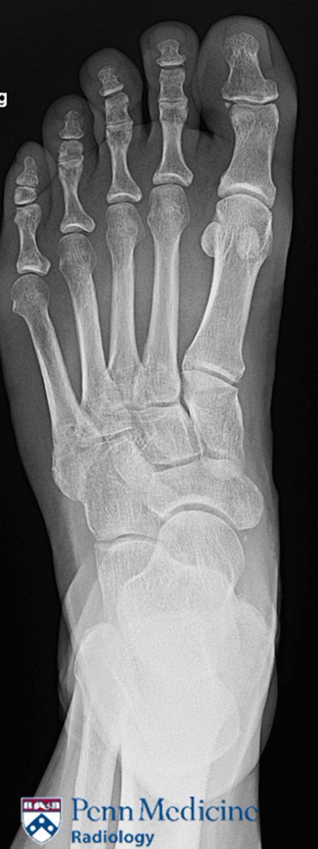 What's your diagnosis? 63-year-old woman with significant left forefoot pain #radiology @PennRadiology bit.ly/3GRagW3
