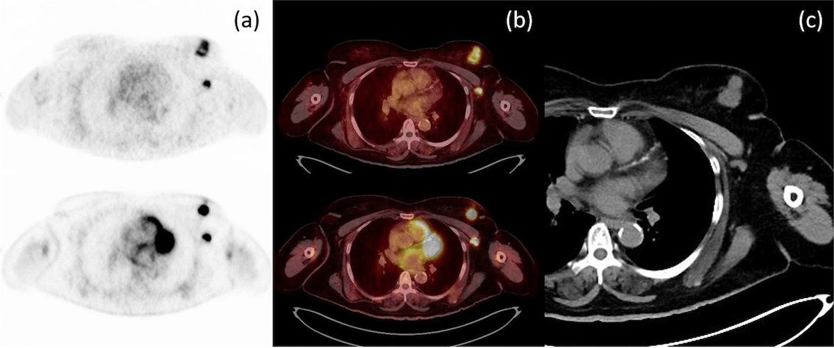 FES-PET better than FDG-PET in breast cancer patients #radiology #breastcancer bit.ly/47dNmmy