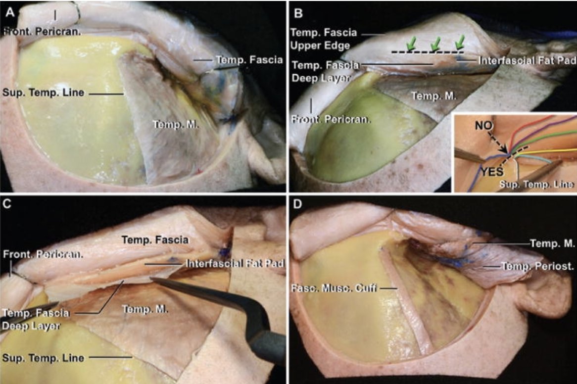 Which method do you prefer (myocutaneous, subfascial, interfascial) for pterional craniotomy or its extended variants, and why?