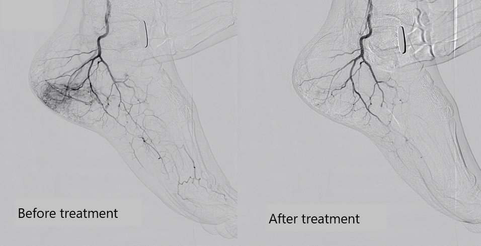 Plantar fasciitis case: This patient experienced left heel pain for about six months, unable to walk. We observed tenderness at the attachment point of the plantar fascia and administered two intra-arterial injection treatments, which we refer to as 'Dochu' treatment.
#heelpain