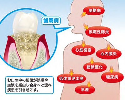歯周病が全身に及ぼす影響  https://t.co/xEDIF76Zxd https://t.co/fUHTW39uxd<a href="/tag/mytwitteranniversary"class="tags"><span>#mytwitteranniversary</span></a>