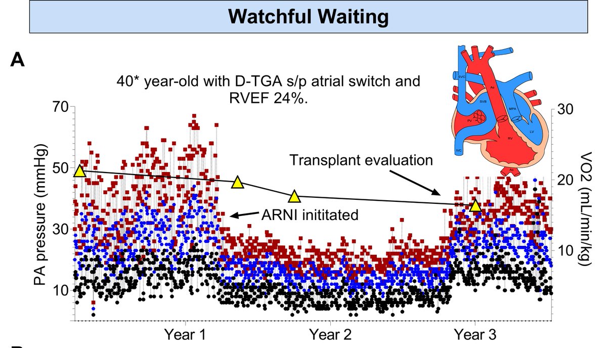 Thanks @Heart_BMJ for publishing our paper on use of CardioMEMS in patients with D-TGA s/p atrial switch and ccTGA, describing utility of implanted hemodynamic monitoring for pulmonary hypertension.