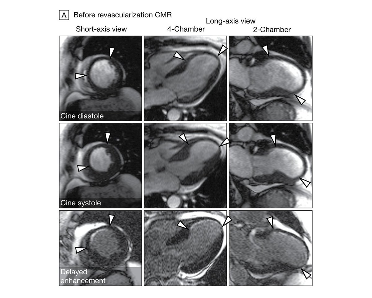 Myocardial viability testing does not identify patients with ischemic cardiomyopathy who benefit from PCI. Findings suggest that the extent of dysfunctional yet viable myocardium was not associated with revascularization outcomes. @revived_BCIS2 ja.ma/3NpPwbO