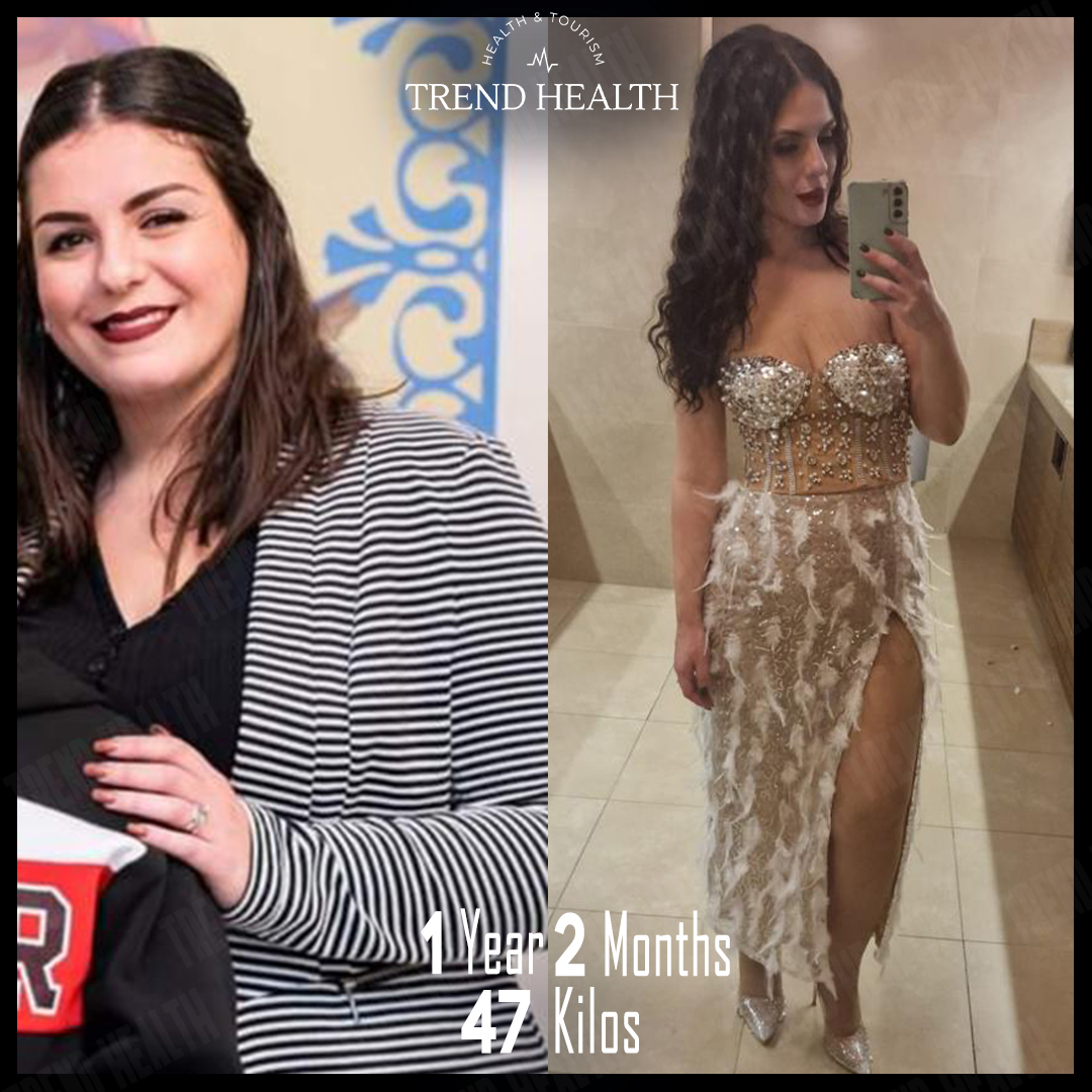 Andonia❤️

#beforeandafter #beforafterweightloss #sleevegastrectomy #sleevesurgery #obesitysurgery #weightlossjourney #weightlosstransformation #gastricsleeve #gastricbypass #weightlossurgery #trendhealth #healthtourismturkey #healthtourisminturkey #healthtourism