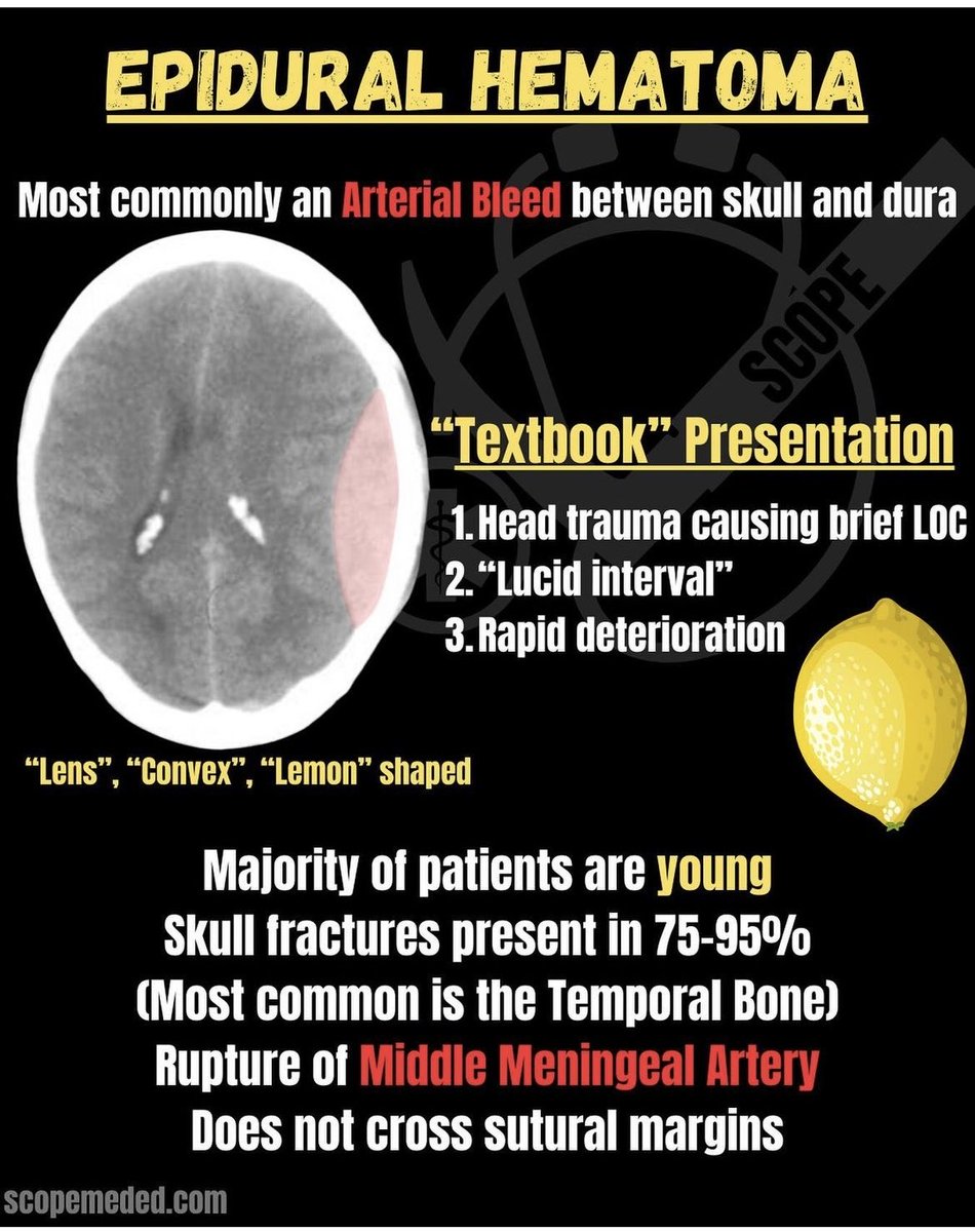 Epidural hematoma from scope medicine