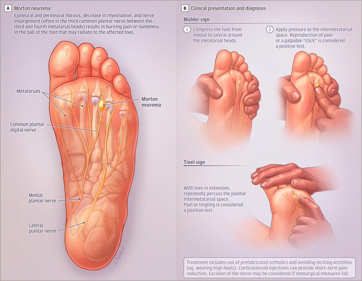 Just published in JAMA 🔥 🦶 Common Painful Foot and Ankle Conditions: A Review 👇👇👇 pubmed.ncbi.nlm.nih.gov/38112812/