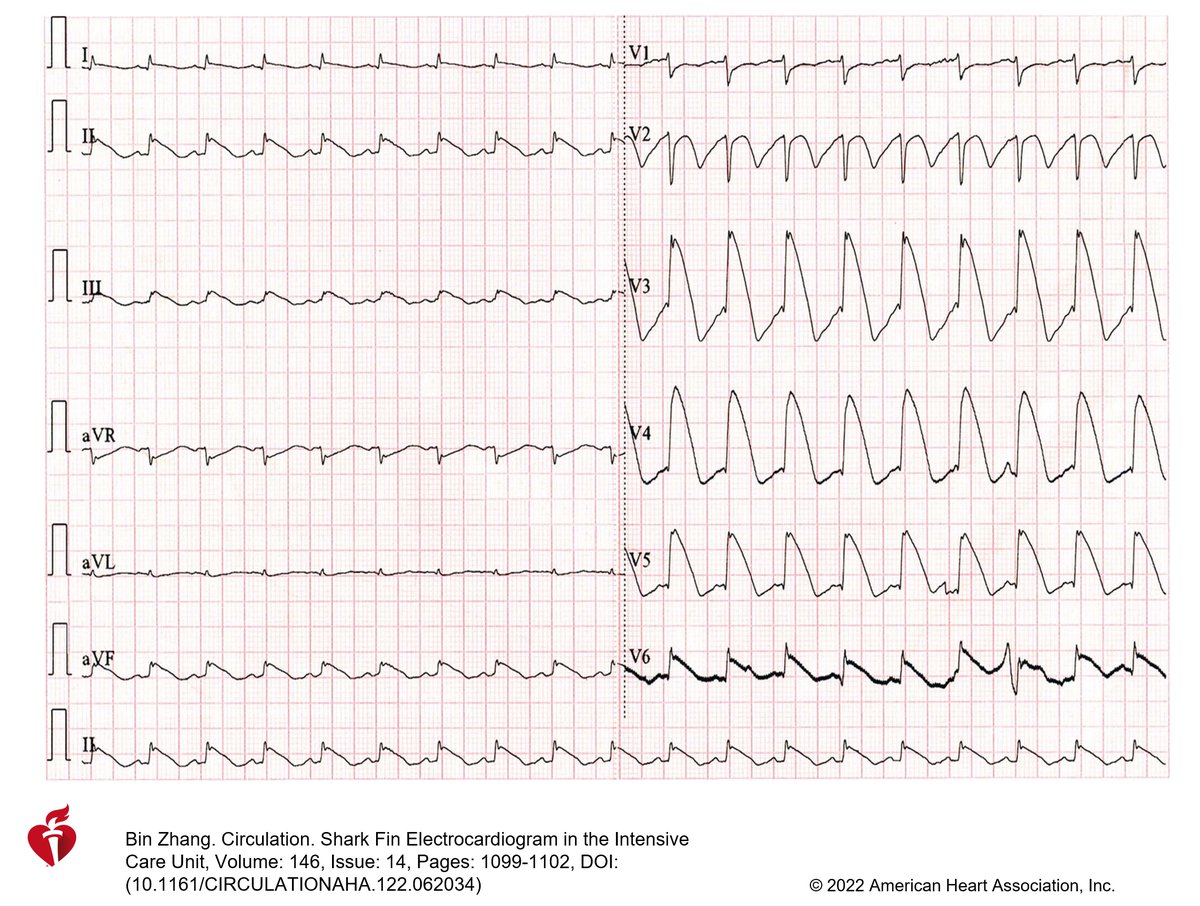 I like this ECG; what do you think is the diagnosis?