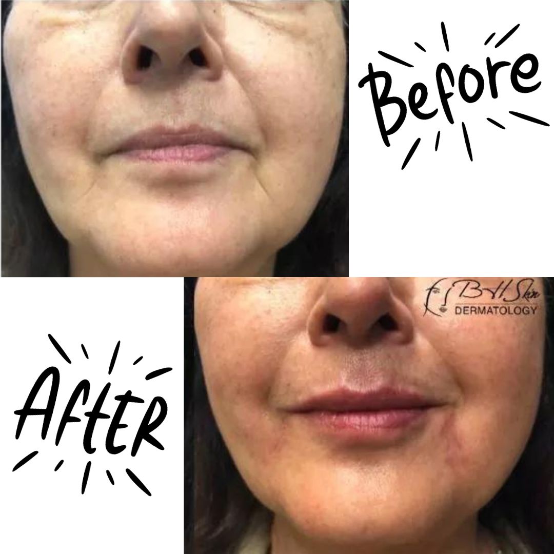 Check out this beautiful before and after! 🙌

Procedure: Filler – Lips and Marionette Lines

#BHSkin #BHSkinDermatology #Dermatology #Dermatologist #LADerm #LADermatologists #Encino #Glendale #HealthySkin #GlowingSkin #SkinTips #Youthful