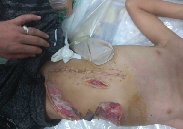 Mensaje SOS desde #Gaza  Os presento a Ziad, es el hijo de un amigo, tiene 13 años y un francotirador le ha reventado por la espalda con 2 balazos.  Está en el Europeam Hospital de Khan Younis y sus padres buscan de manera desesperada una evacuación porque los médicos dicen que