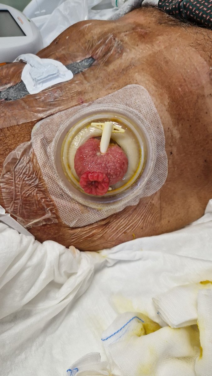 How to NOT perform an #ileostomy.
<a href="/darioparini/">Dario Parini</a> <a href="/ABondurri/">Andrea Bondurri</a> <a href="/Gianluc15924656/">Gianluca Rizzo</a> <a href="/drfrancescopata/">Francesco Pata</a> <a href="/missto_it/">MISSTO</a> <a href="/YouSICCR/">Y-SICCR</a> <a href="/Some4SurgeryIT1/">@Some4SurgeryITeam</a> <a href="/me4_so/">SoMe4Surgery</a> @Cirbosque <a href="/SoMe4Proctology/">SoMe4Proctology</a> <a href="/ColorectalDisC1/">@ColorectalDisCenter</a> <a href="/colo_research/">#ColorectalResearch</a> <a href="/colorectaltweet/">Colorectalsurgery</a> #surgery #colorectalsurgery #ostomy <a href="/WOCNSociety/">Wound, Ostomy, and Continence Nurses Society</a>  <a href="/ECETstomacare/">ECETstomacare</a>