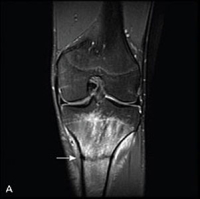 drcorenman's tweet image. Two groups that have the greatest risk of #stressfractures of the #lowerextremities are the athletic and the military populations. In either population, prolonged impact activities (running, weight lifting, etc.) set the stage for these #overuse fractures. medilink.us/9x8e