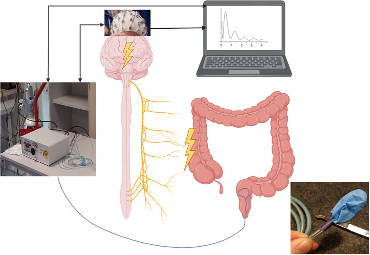 Here, rectal sensitivity, independent of #T2D duration, was associated with GI-mediated glucose disposal, alluding to a potential link between autonomic nerve function and gut-derived mechanisms governing glucose homeostasis.
🇳🇴🇩🇰
Open access: pubmed.ncbi.nlm.nih.gov/38059537/