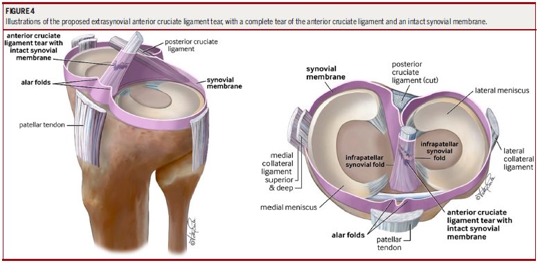 Andreas Serner (@aserner) on Twitter photo <a href="/EarleArt/">VEarleMedicalArt</a> recently did these great illustrations of the theory of an extra synovial ACL tear
In <a href="/JOSPT/">JOSPT Community</a> Cases
Open access: t.ly/c6b4B <a href="/EarleArt/">VEarleMedicalArt</a> recently did these great illustrations of the theory of an extra synovial ACL tear
In <a href="/JOSPT/">JOSPT Community</a> Cases
Open access: t.ly/c6b4B