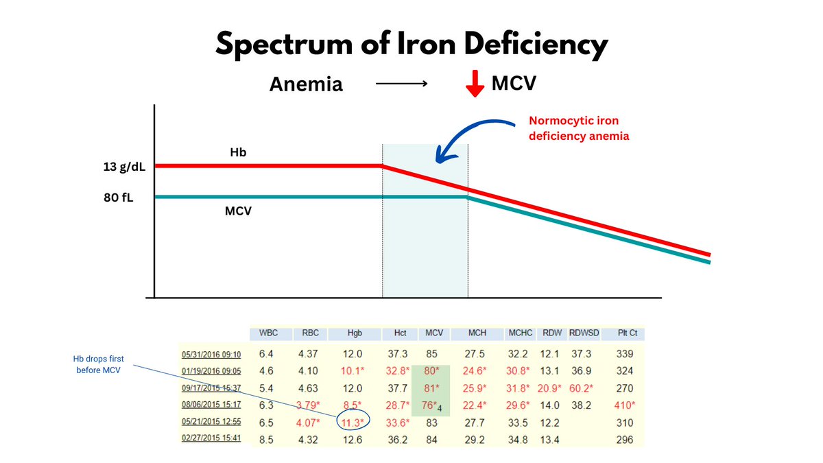 1/3 TEMPORAL CHANGES IN MCV and Hb in IDA If you read the literature