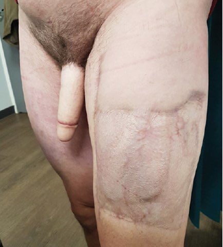 IanBAnderson69's tweet photo. @untapbrainworms @DR_RAGEBERG @Hiya654321 @athena_pinecone @AxOfBrevity @SoupTransphobes Looks fucked up healed too lol looks like Frankensteins thumb 😂 https://t.co/aZ2mzMZ1F3