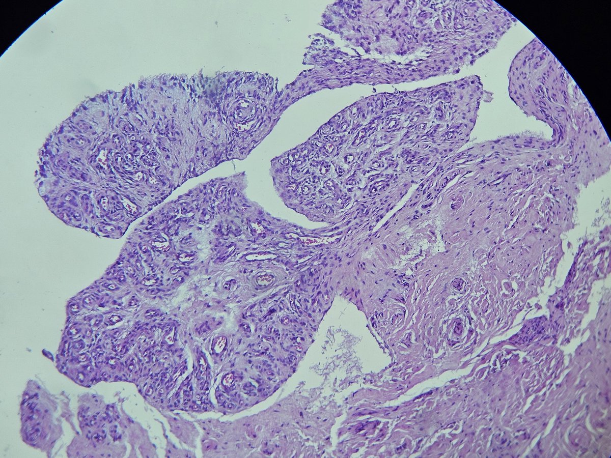 AlaaRowaid_88's tweet photo. 🔬46 years old male with right knee pain and swelling since 1 year .
🔬MRI : show feature of synovial chondromatosis.
🔬Any comments on these histopathological pictures below. ?? https://t.co/UhwCLi4vws
