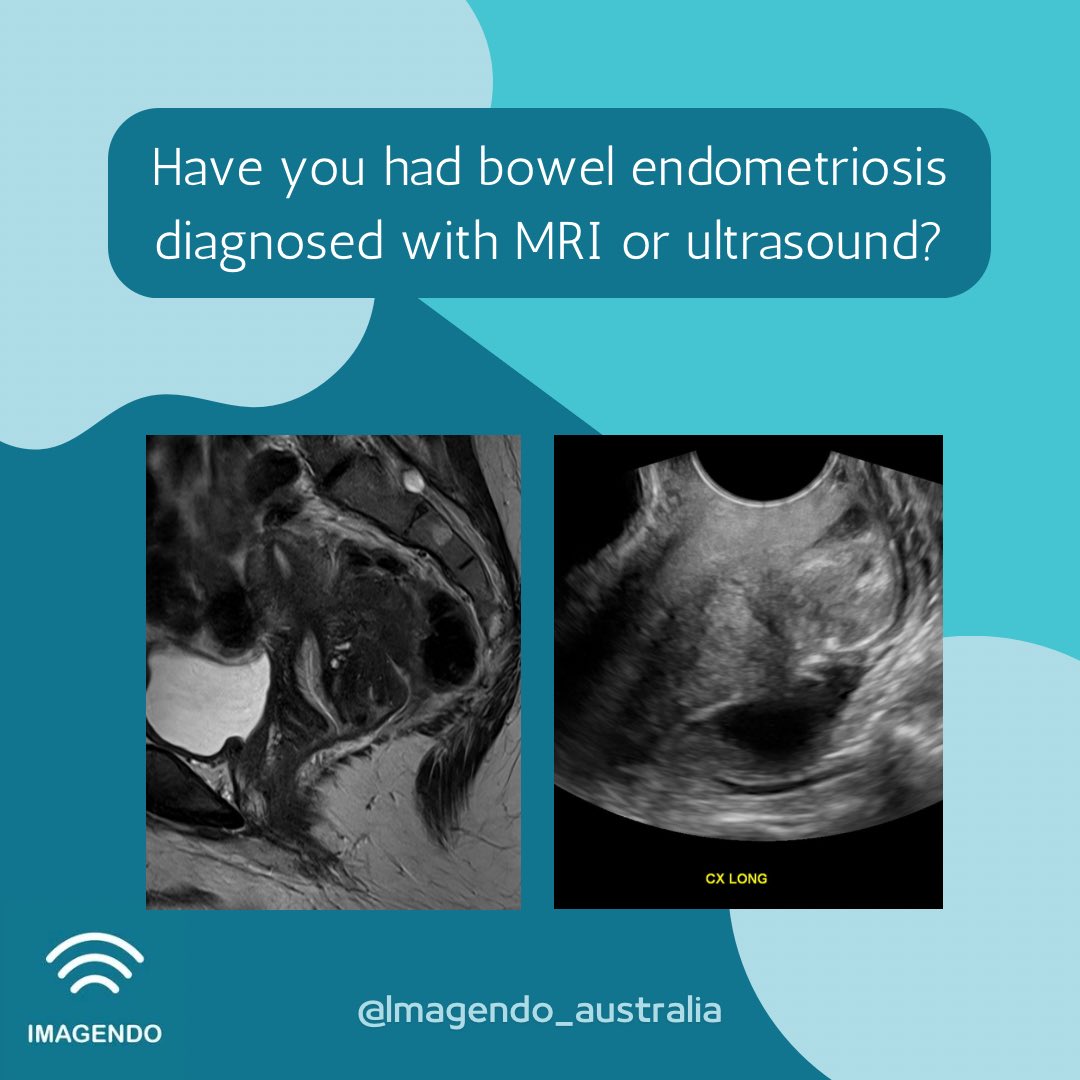 The IMAGENDO team need more #MRI and #ultrasound scans showing #endometriosis with the bowel If you’ve been diagnosed with bowel endo on imaging, consider donating your scans to our project to help improve diagnosis for others See how here: imagendo.org.au/stage-one/ Pls RT