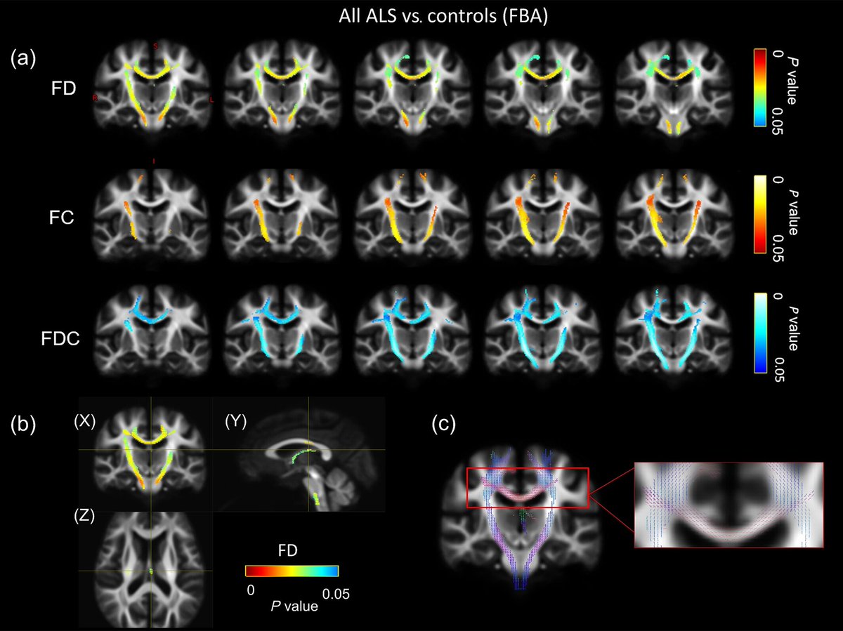 thmonk_pf's tweet photo. ALSのfixel based analysis(FBA)およびneurite orientation dispersion and density imaging(NODDI)による評価
・全ALSでCST/CCなどでFD/FDC低下。NODDIでNDI低下
・急速進行群ではCSTのFC低下
進行速度とFCが相関
認知障害群ではCCのFD低下
#ALS
#NODDI
#papers
https://t.co/TfGTThMvuz https://t.co/JBLCU2RMKb