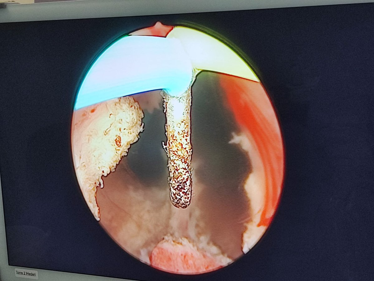 Some BOO cases can be resolved simply, as in this case. young patient, with children and bad flow. 18g prostate. High detrusor pressure at maximum flow.
#UroSoMe <a href="/so_uro/">UroSoMe</a> #prostate