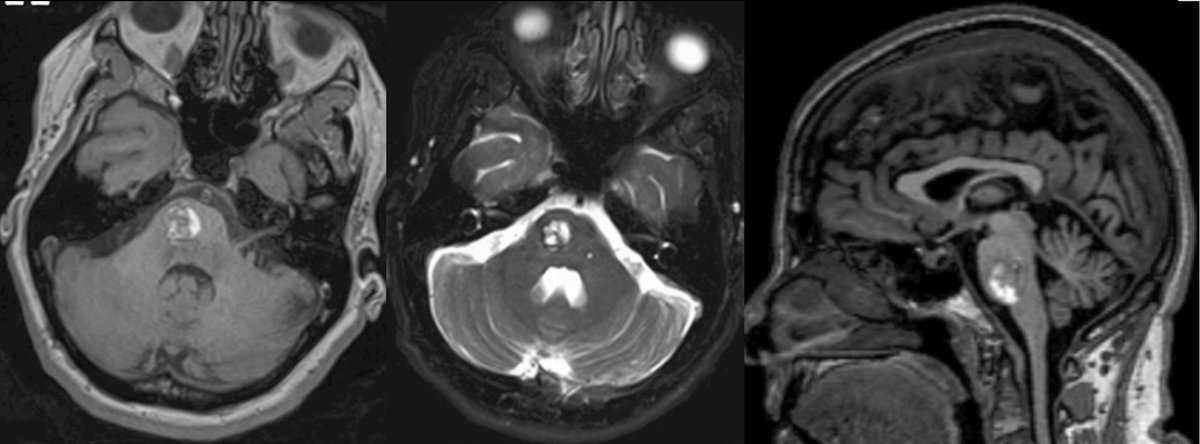 #MorcosChallenge In this pt w/ a pontine cavernoma that goes below the level of the IAC, do you think this could be resected completely using a Kawase approach? Why/why not? @EvaWuMD @neurosurgatlas @medclinicalcase @e1v1m1 @neurosurgeryof @cvsection @neuroangioA @neurosurgery101