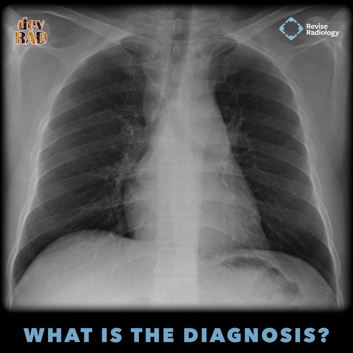 What is the diagnosis?

#Medtwitter #FOAMrad