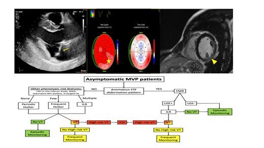 Edgardo Alania (@ed_alania) on Twitter photo 🔴 Arrhythmic mitral valve prolapse: a practical approach for asymptomatic patients <a href="/ESC_Journals/">European Society of Cardiology Journals</a> #cardioEd #Cardiology #echofirst #Whycmr 🔴 Arrhythmic mitral valve prolapse: a practical approach for asymptomatic patients <a href="/ESC_Journals/">European Society of Cardiology Journals</a> #cardioEd #Cardiology #echofirst #Whycmr