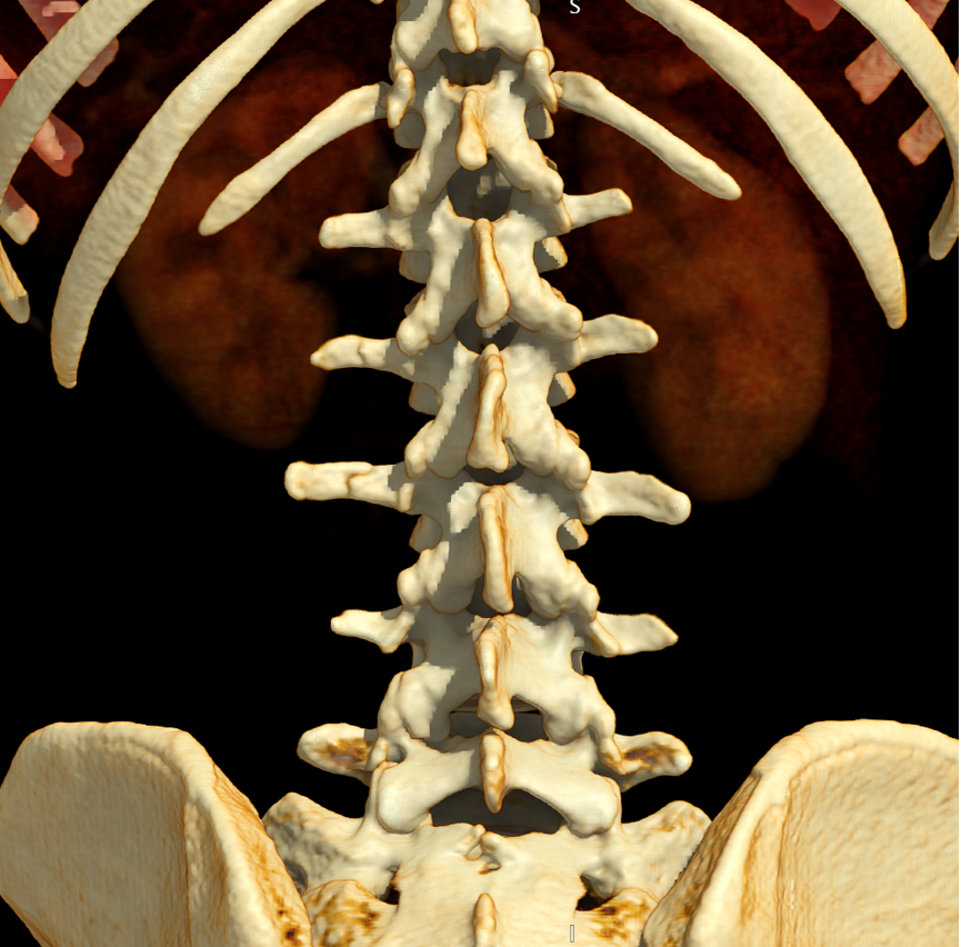 Nondisplaced left transverse process fractures on 3D CT of the lumbar spine.
#FOAMed