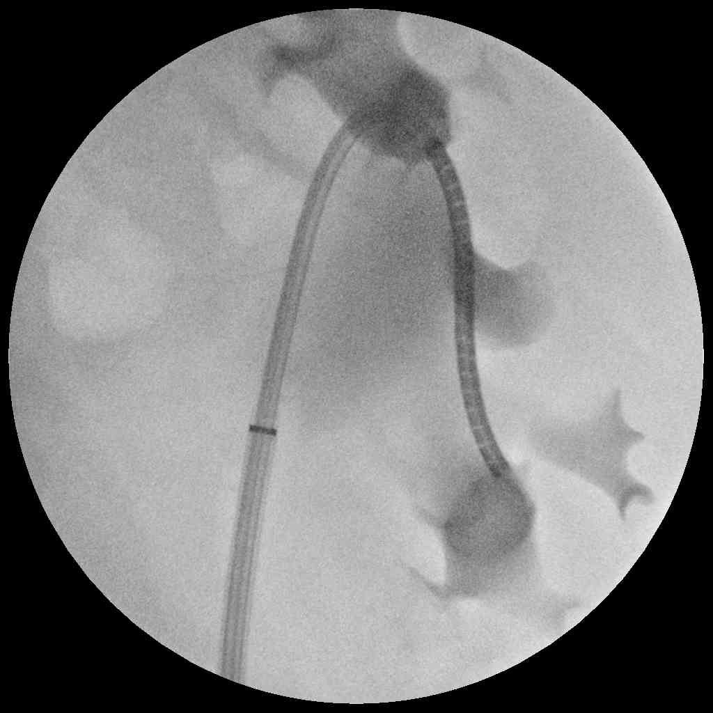 Failed flexible ureteroscopy…

What do you do when you can’t reach lower pole stone bearing calyx using both active and passive deflection with your flexible?

@endouroacademy