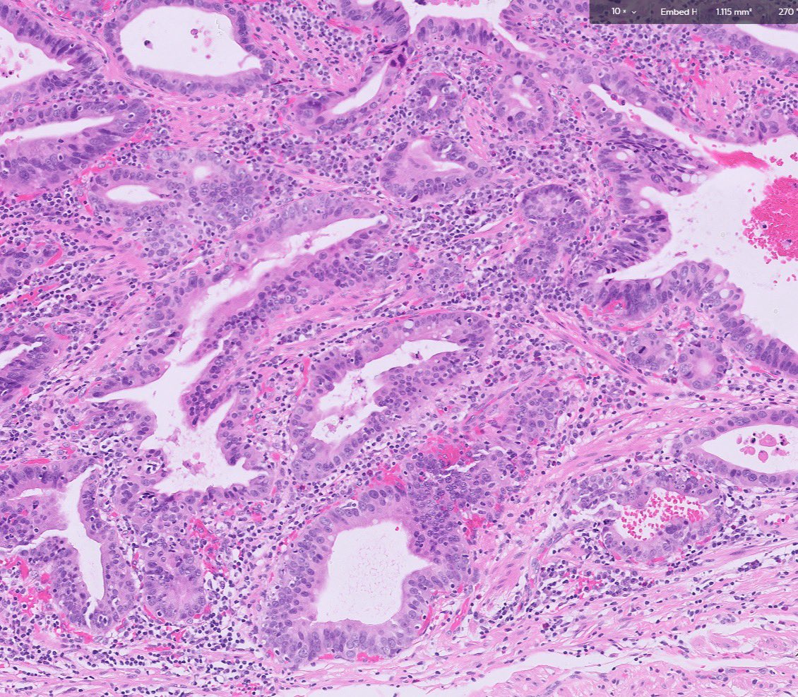 Esophageal deep mucosal resection for Barrett’s #surgpath #pathtwitter #Gipath