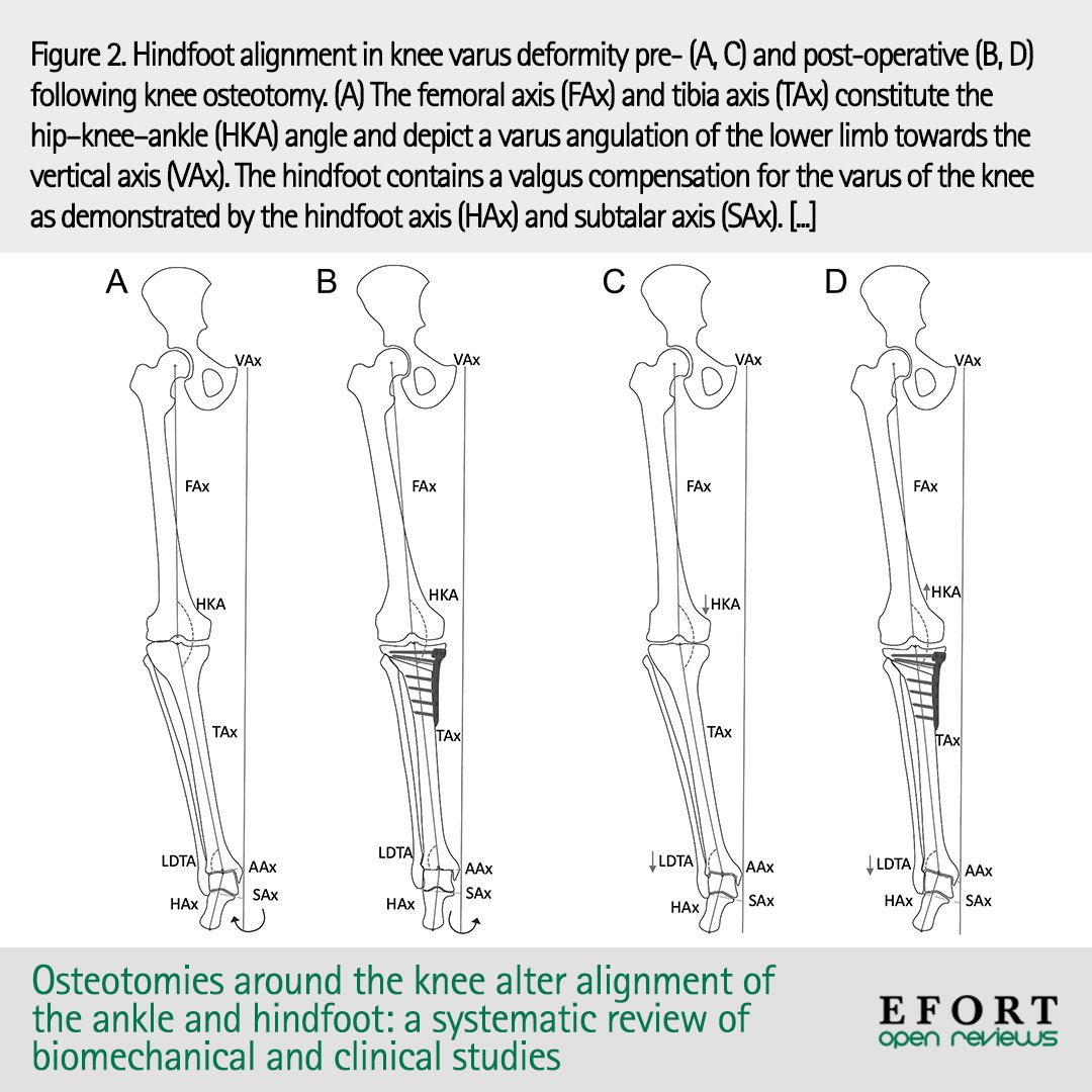 EFORTnet's tweet photo. #OpenReviews article provides a systematic review of all studies investigating biomechanical and clinical outcomes related to the #ankle/ #hindfoot alignment following #knee #osteotomy 📄 https://t.co/xE1imEMb1T #kneeosteotomy #deformitycorrection #orthopedics #openaccess https://t.co/8dA47Pdgqs