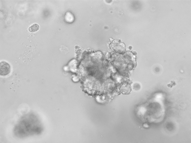 @TheCleversLab and the @CancersRare Team (IARC/WHO) developed the first organoid model for neuroendocrine tumors. During the development of this new model, they already discovered a potential new treatment for pulmonary NETs: hubrecht.eu/nets. @TalyaDayton @nl_alcala