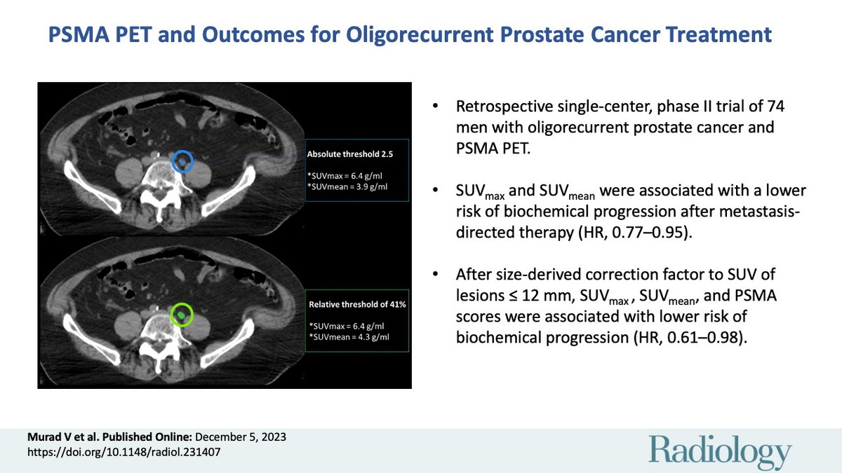 This new study analyzed prostate-specific membrane antigen PET parameters associated w biochemical progression-free survival in patients w oligorecurrent prostate cancer treated w metastasis-directed therapy. bit.ly/3NbsMfB