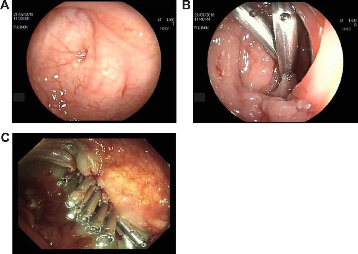 BMJ Open Gastro (@bmjopen_gastro) on Twitter photo Read the paper by Waddingham and Kamran et al on
"Complications of colonoscopy: common and rare—recognition, assessment and management" via
bmjopengastro.bmj.com/content/10/1/e…
<a href="/tsiamoulos/">Zach Tsiamoulos</a> <a href="/matthewbanks/">matthewbanks</a>
#Colonoscopy Read the paper by Waddingham and Kamran et al on
"Complications of colonoscopy: common and rare—recognition, assessment and management" via
bmjopengastro.bmj.com/content/10/1/e…
<a href="/tsiamoulos/">Zach Tsiamoulos</a> <a href="/matthewbanks/">matthewbanks</a>
#Colonoscopy