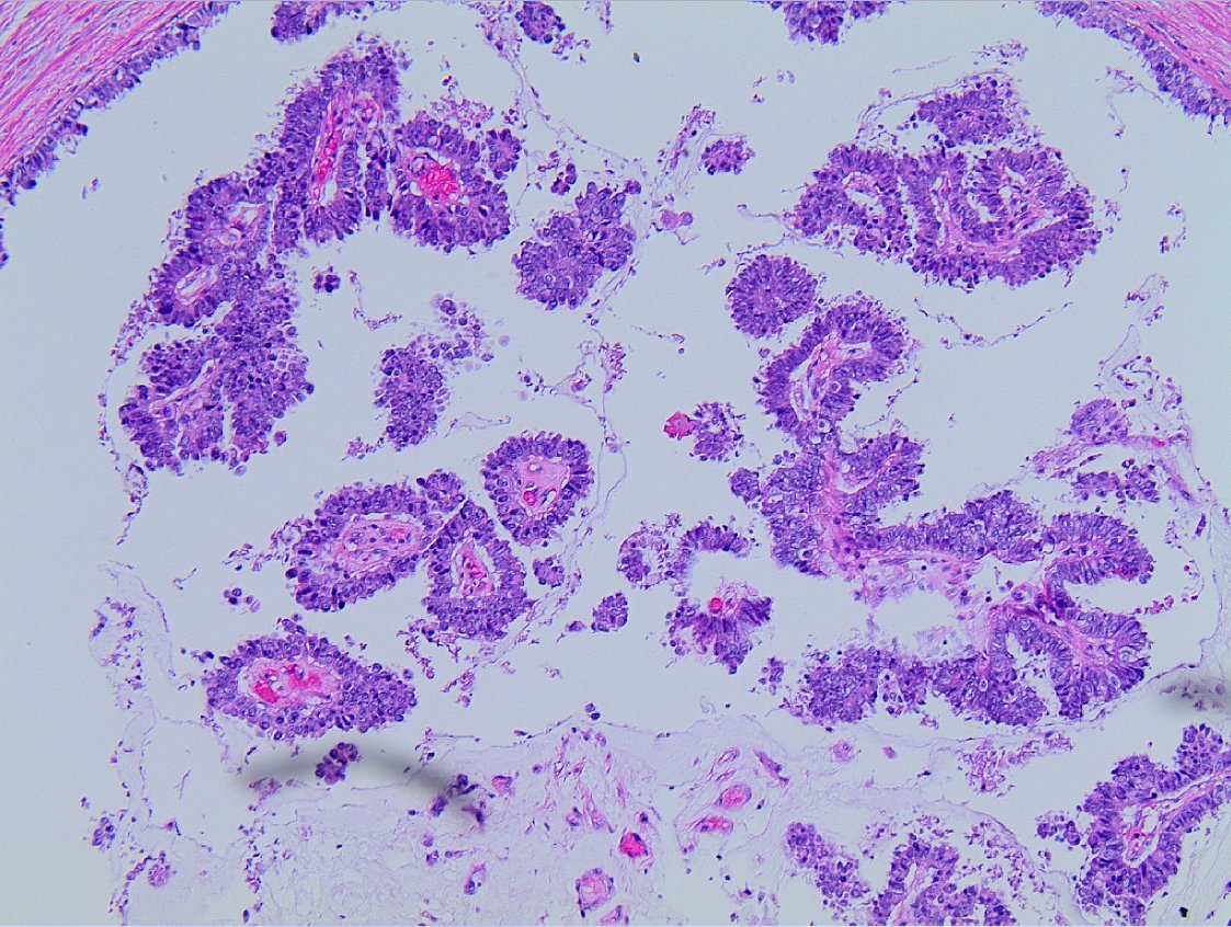 Papillary lesion on breast excision with no myoepithelial layer within and outside. Is this invasive carcinoma or papillary DCIS? How will you sign out? #breastpath