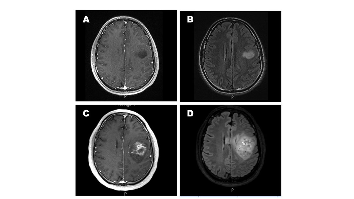 Adolescents and young adults (AYA) with CNS tumors are underrepresented in clinical research studies. In a new @JCO_ASCO review, we provide recommendations for reducing research gaps and improving care to AYA patients. tinyurl.com/2bekk9d6