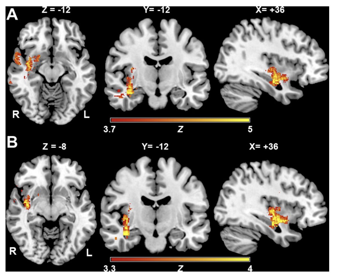 #MondayTip

☝️Myocardial injury is related to AIS even without prior cardiac disease, also called the #stroke_heart syndrome

🧠Acute lesions of the central autonomic network, especially the right hemispheric insula, are associated with an impaired LVEF🫀

svn.bmj.com/content/8/4/301