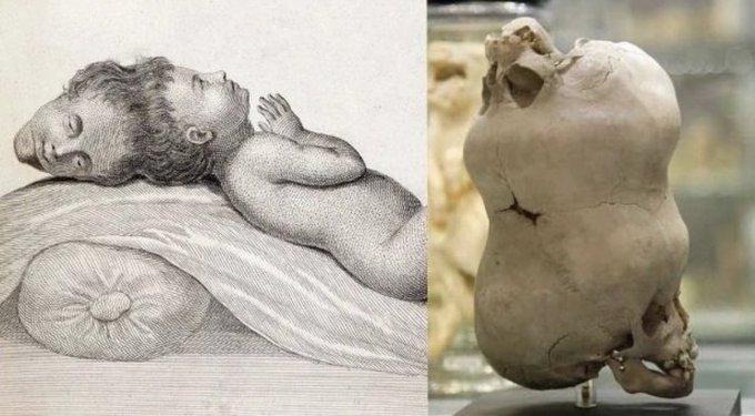 In 1783, a boy with two functioning heads was born in Mundal Guat, Bengal, India. 

The sight startled the midwife so much that she  threw the boy into a fire, though he survived with minor injuries.  

Seeing a chance to profit, the parents took the boy to Calcutta where people