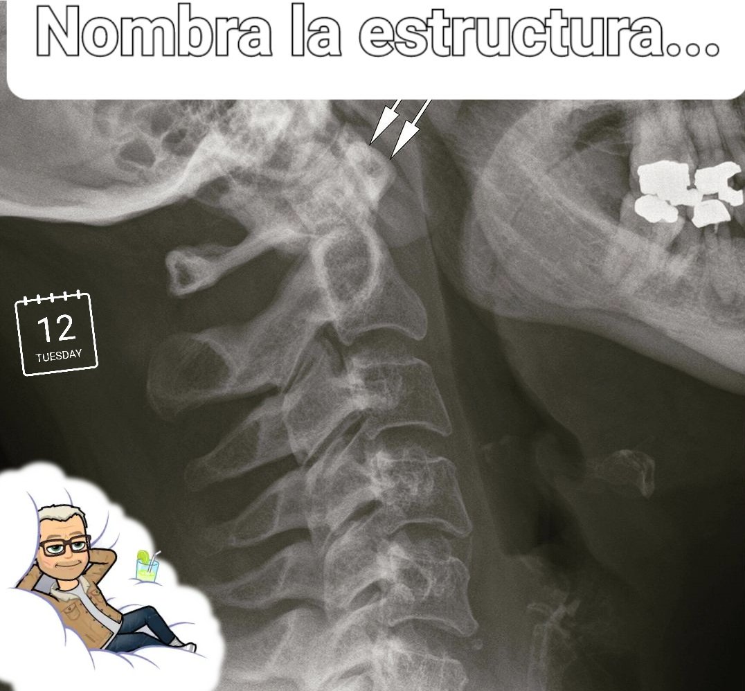 SanitariaR's tweet photo. P. Qué estructura señala la flecha?
🔁 la respuesta
#anatomiaradioloxica_2023
#CalendariodeAdviento 
#TSIDMN https://t.co/CwdDLz2Kuc
